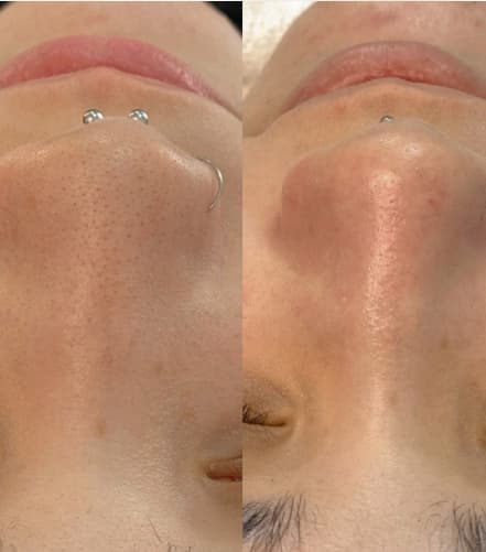 Limpeza de Pele Premium